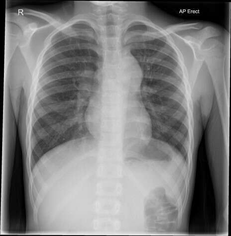 chest x-ray showing bulky left mediastinum